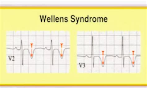 Rare Case of Wellens syndrome progressing from type A to classic type B ...