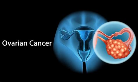 Ayurvedic Remedies For The Treatment For Ovarian Cancer