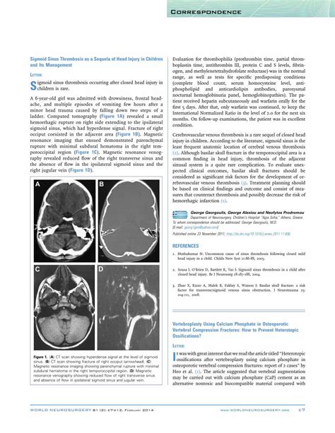 (PDF) Sigmoid Sinus Thrombosis as a Sequela of Head Injury in Children ...