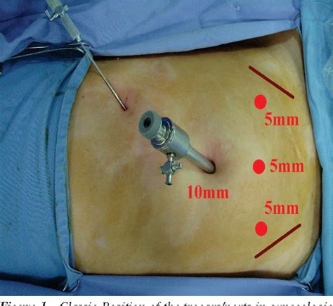 Figure 3 from How do I treat Ovarian Dermoid Cyst by Laparoscopy ? | Semantic Scholar