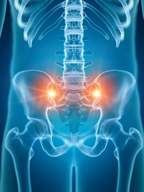 Sacroiliac Joint Dysfunction X Ray