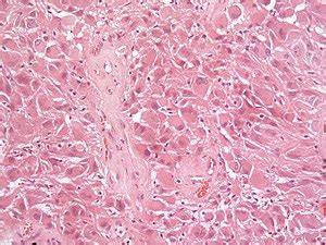 Astrocytoma - Libre Pathology