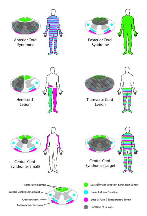 [Figure, Comparison of Spinal Cord Lesions...] - StatPearls - NCBI Bookshelf