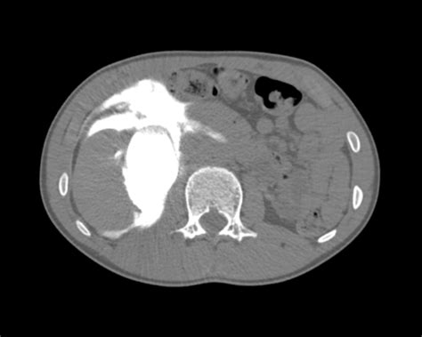 CT Case 043 • LITFL • CT scan interpretation