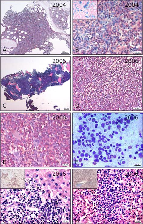 Differential diagnostic challenge of chronic neutrophilic leukemia in a patient with prolonged ...