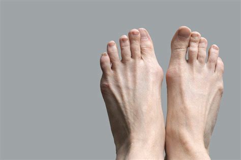 Guide Hallux Valgus & Hallux Valgus Treatments | The Foot Practice