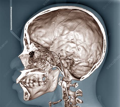 Human skull, 3D CT scan - Stock Image - C048/0736 - Science Photo Library