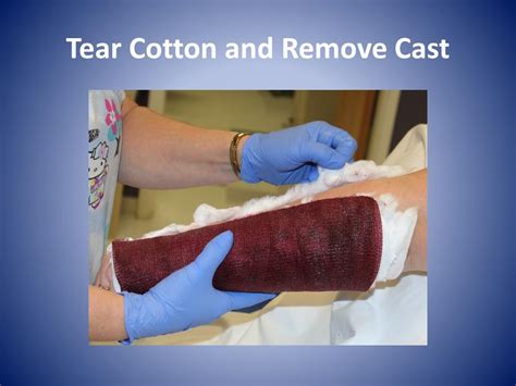 PPT - Fiberglass Short Arm Cast Application and Removal PowerPoint ...