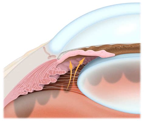 Narrow-Angle Glaucoma - Central Valley Eye Medical Group