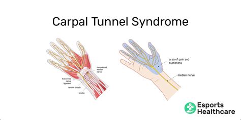 Carpal Tunnel Syndrome Vs Tendonitis - Quotes Trendy New