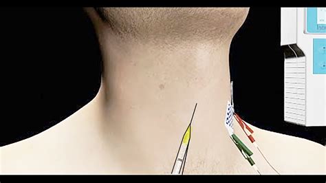 Spasmodic Dysphonia Treated with EMG Guided Botox Injection - YouTube