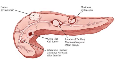 Pancreatic Cysts | Columbia Surgery