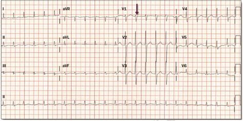 What is AV Nodal Reentrant Tachycardia (AVNRT)? | Mark McCauley MD PhD