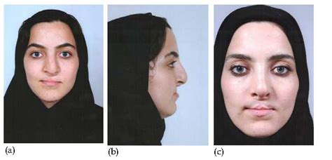 Cleft Lip and Palate Surgery | IntechOpen