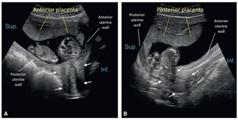 Placenta and Umbilical Cord | Radiology Key