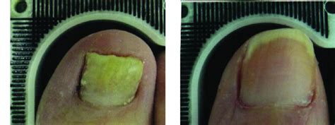 Laser Therapy For Toenail Fungus Specialist - Clifton, NJ: Premier Podiatry: Velimir Petkov, DPM ...