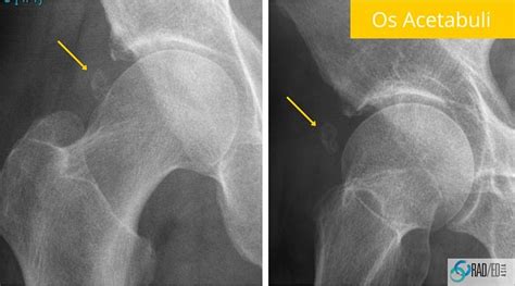 Hip MRI ? Show me the Xray: Acetabular Rim Ossifications. How to make ...