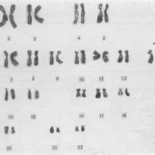 Karyotype of Case 1, showing 47 chromosomes including an extra... | Download Scientific Diagram