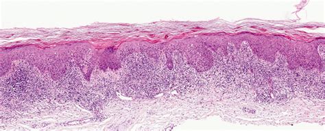 Pathology Outlines - Lichen planus