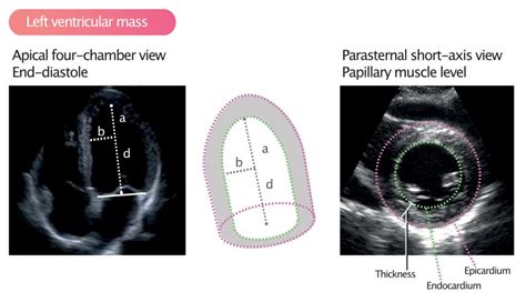 Left ventricular mass and volume (size) – Cardiovascular Education