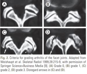 Facet Joint Arthropathy - Sports Medicine Review