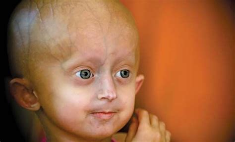 1000+ images about Progeria on Pinterest | Aspirin, Sam berns and Bake sale