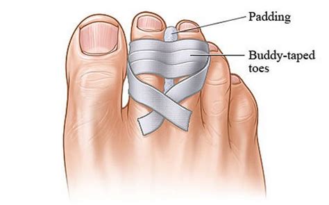 How to Fix a Dislocated Toe (at home) Treatment ? - (updated in 2022)