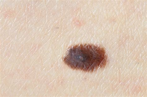 What Does Skin Cancer Look Like? | The Dermatology Center Of Indiana