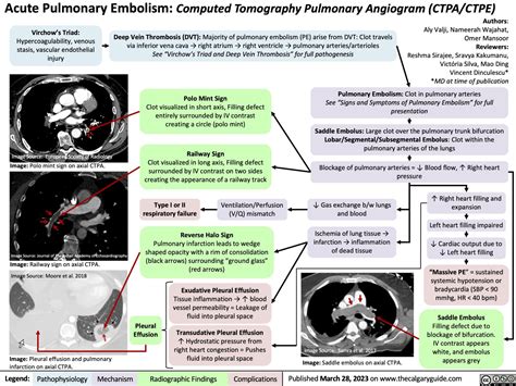 Acute Pulmonary Embolism on CTPA | Calgary Guide