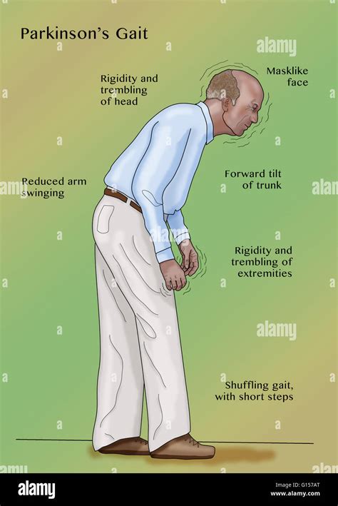 Parkinsonian Gait