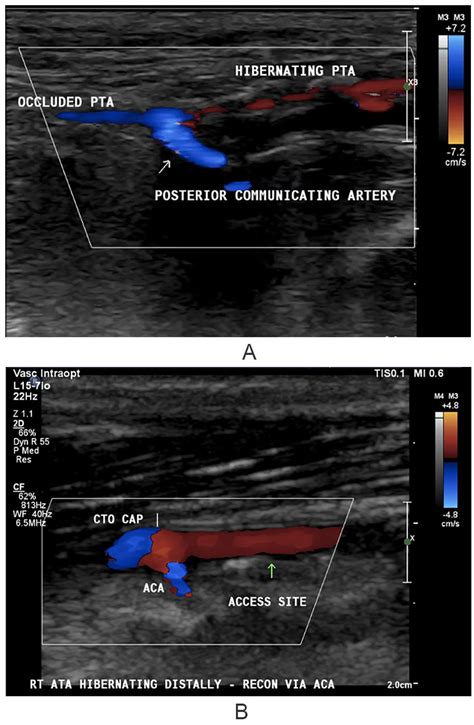 Peroneal Artery Ultrasound