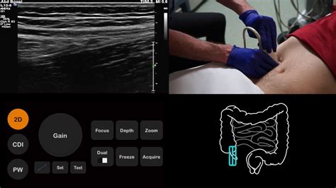 Radiopaedia Appendicitis Ultrasound Appendicitis is inflammation of the vermiform appendix