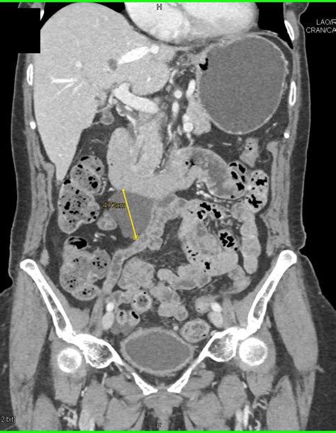 Mesenteric Cyst - Gastrointestinal Case Studies - CTisus CT Scanning