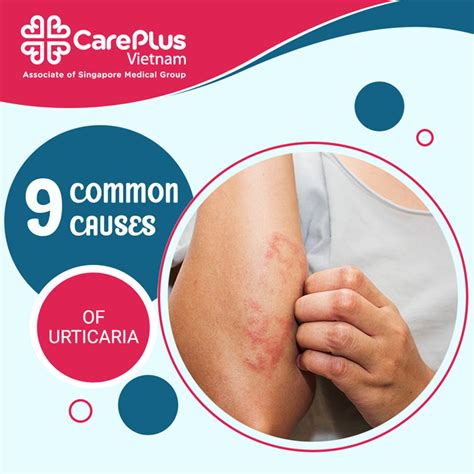 9 Common causes of urticaria