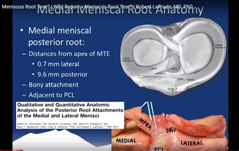 Meniscal Root Tears could be a silent Epidemic — OrthopaedicPrinciples.com