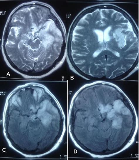 Neurosyphilis Mri