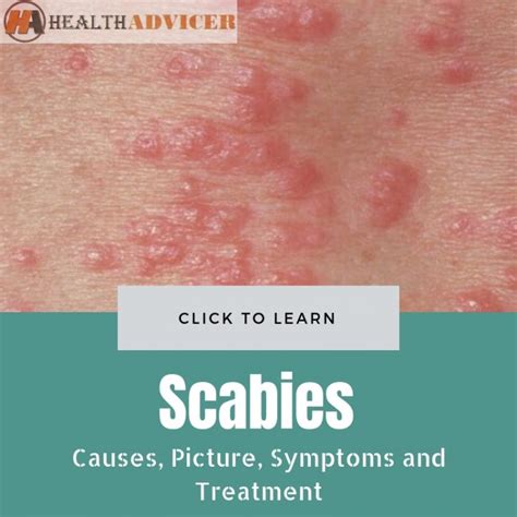 Scabies Rash Symptoms Causes Treatment And Prevention - vrogue.co