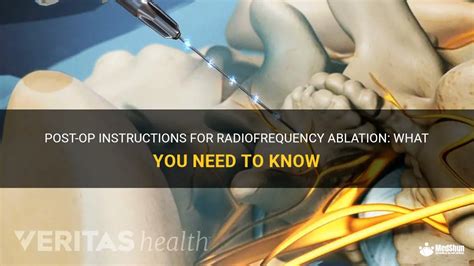 Post-Op Instructions For Radiofrequency Ablation: What You Need To Know ...