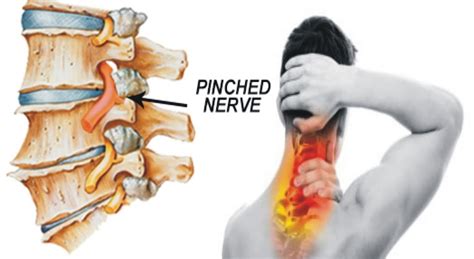 Pinched Nerve - In Neck, Arm, Shoulder - Causes, Symptoms & Treatment