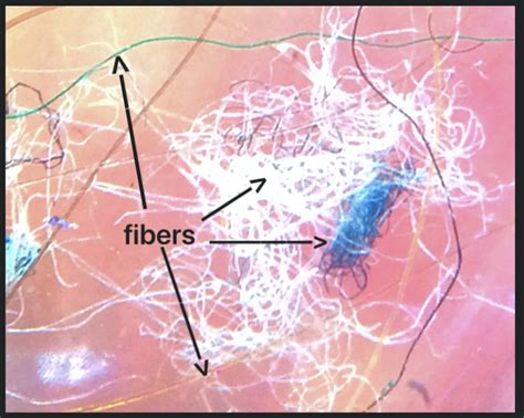 Pin on Morgellons