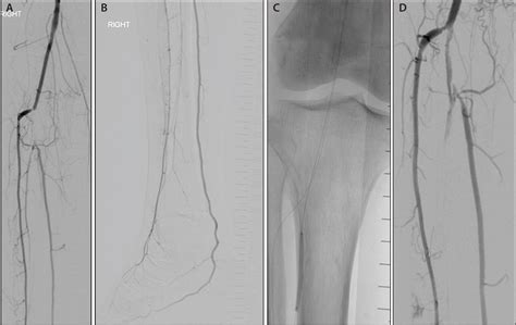 Endovascular Today - Prevention and Management of CLI Complications (May 2016)