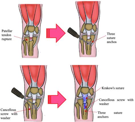 Table 1 From Bifocal Patellar Tendon Avulsion Fractur - vrogue.co