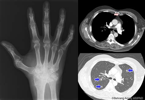 Roentgen Ray Reader: Rheumatoid Arthritis and Lymphoma