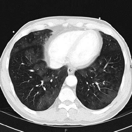 CT scan of chest with contrast, showing bilateral ground glass in fi... | Download Scientific ...