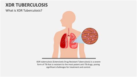 XDR Tuberculosis PowerPoint and Google Slides Template - PPT Slides