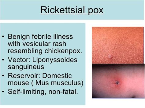 Rickettsial infection - online presentation