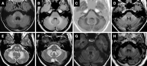 Cerebral MRI illustrating middle cerebellar peduncles involvement ...