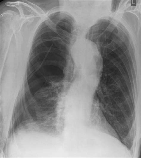 Chest x-ray taken immediately after the insertion of a Heimlich valve... | Download Scientific ...