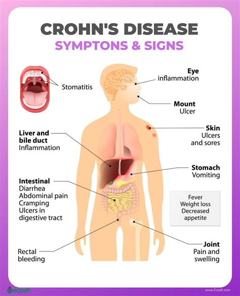 CROHN'S DISEASE - Symptoms, Causes, Risk Factors, Crohn’s Disease Diet ...