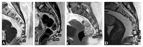 MRI of the sacrococcygeal region showing the coccygeal types: (A) Type... | Download Scientific ...